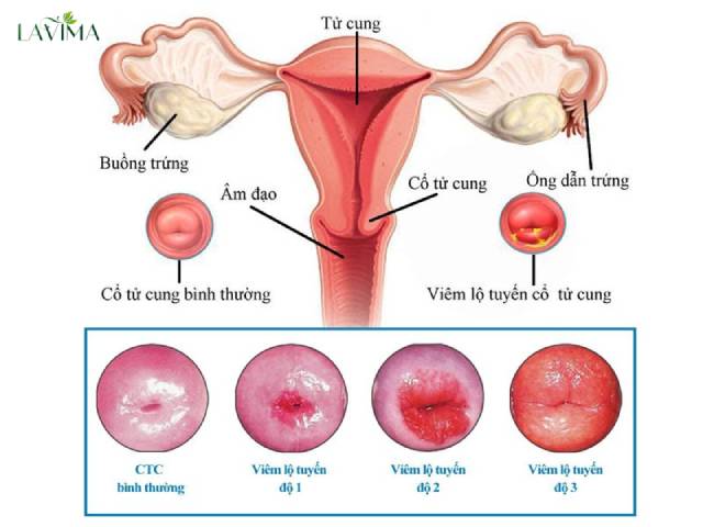 Viêm lộ tuyến cổ tử cung sẽ dẫn đến tình trạng ra huyết trắng có lẫn ít màu