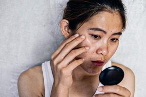 Da xỉn màu, đen sạm khiến bạn tự ti