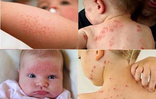 Triệu chứng khi trẻ bị nhiễm trùng da và cách điều trị